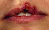 pictures of herpes outbreaks, oral